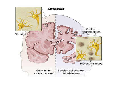 Alzheimer