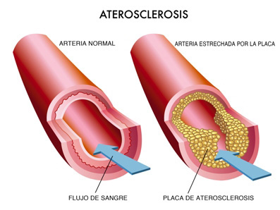 Arteriosclerosis