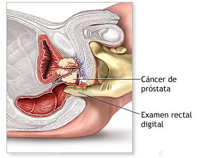 Cancer Postata